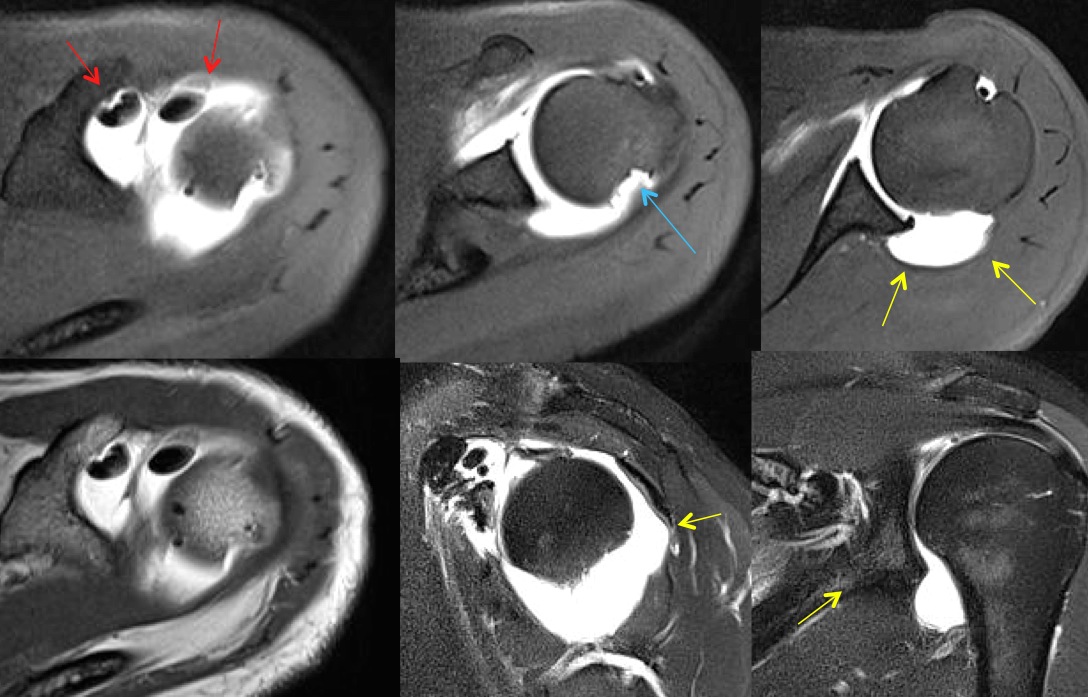 Figure 2 for case MDI and hypertrophy CHL